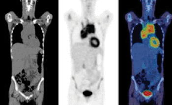 Image:  High-grade uptake on interim PET scan indicating chemoresistance (Photo courtesy of Dr. Sally Barrington, London’s St. Thomas’ PET Imaging Center, UK).